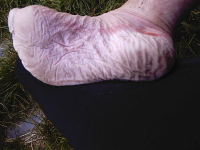 [DSC_0193.jpg]
Jens's heavily blistered foot... (Photo Jens Pohl)