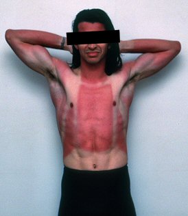 [GuillaumeSunburn.jpg]
Lack of sunscreen while backcountry skiing in spring leads to mother of all sunburns (chinese saying).